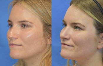 Female patient before and after rhinoplasty