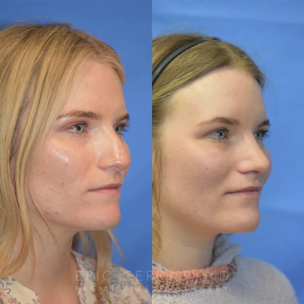Female patient before and after rhinoplasty