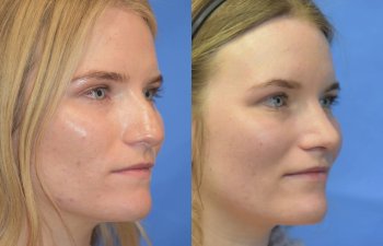 Female patient before and after rhinoplasty