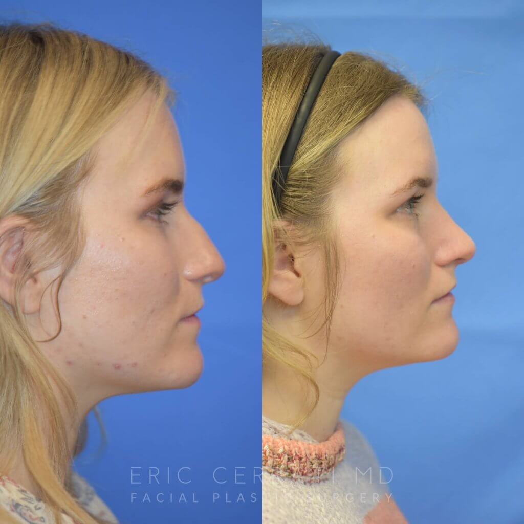 Female patient before and after rhinoplasty