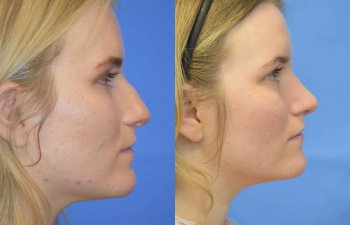 Female patient before and after rhinoplasty
