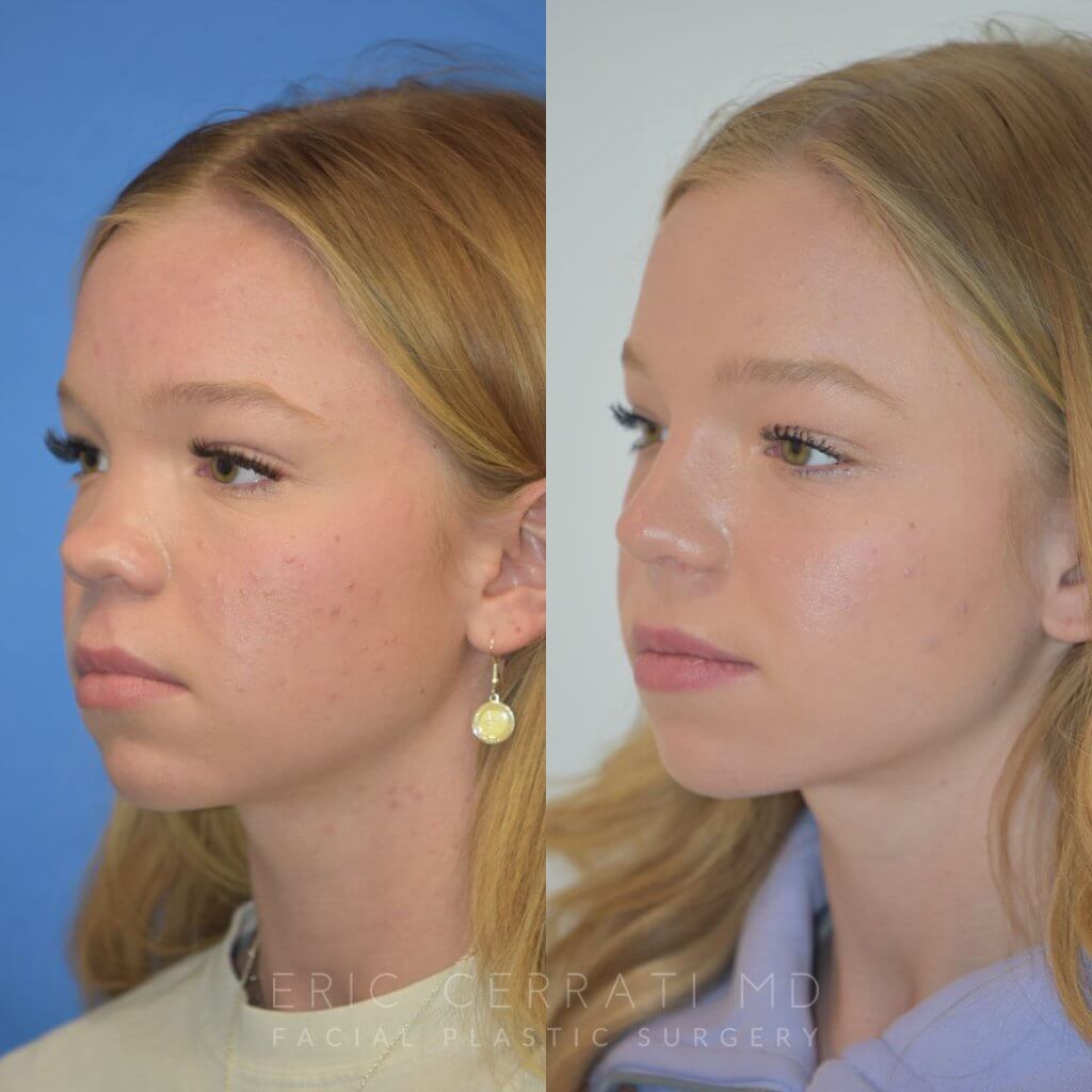 Female patient before and after rhinoplasty