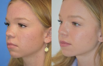 Female patient before and after rhinoplasty
