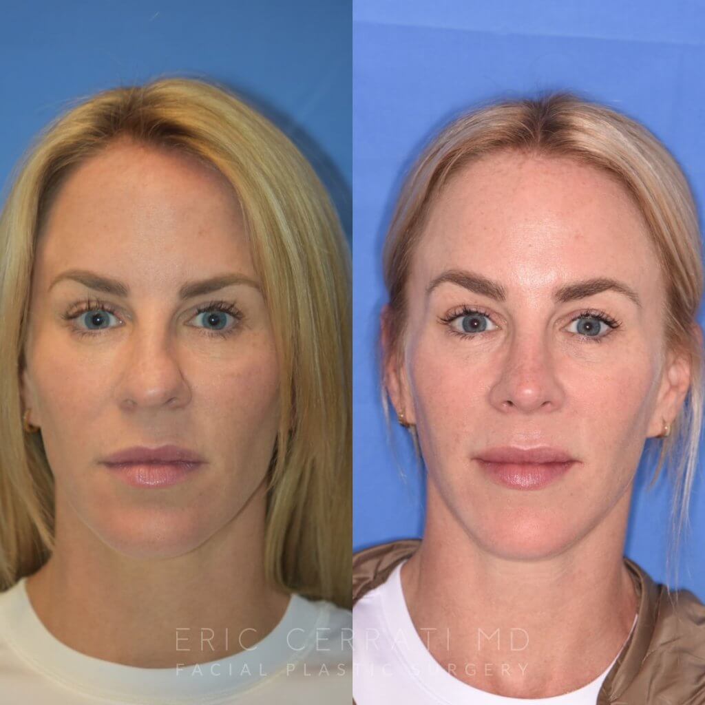 Female patient before and after rhinoplasty