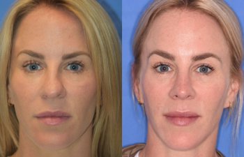 Female patient before and after rhinoplasty