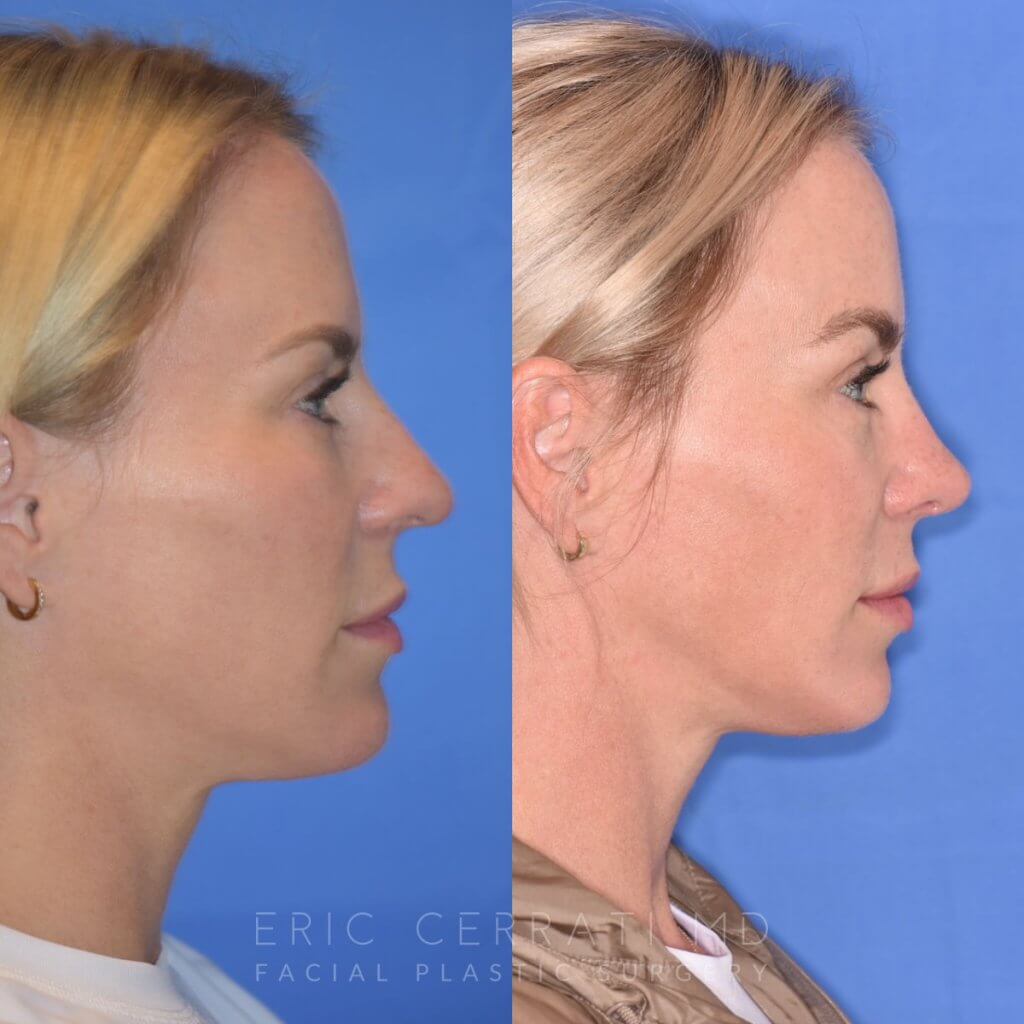 Female patient before and after rhinoplasty