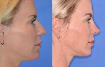 Female patient before and after rhinoplasty