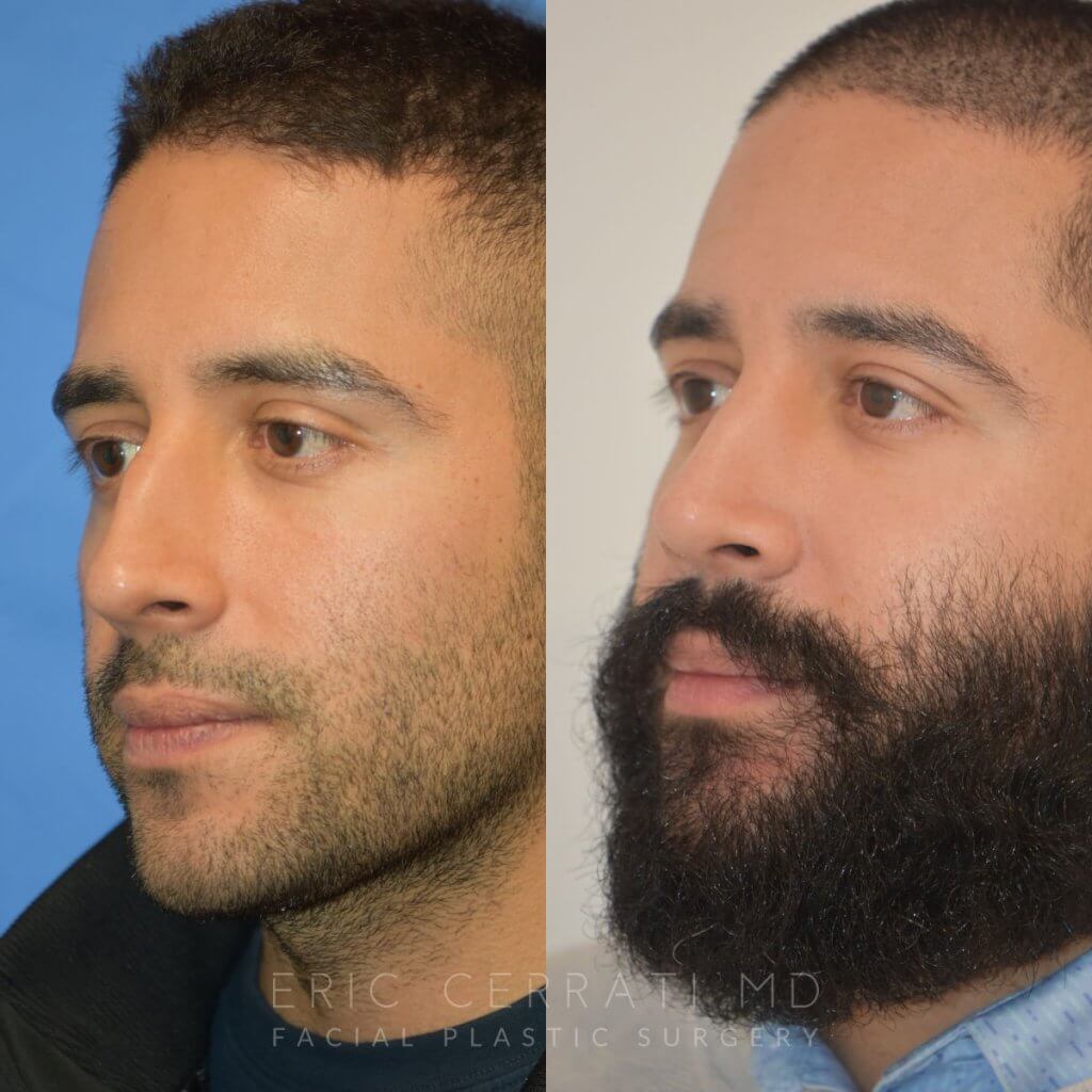 Male patient before and after rhinoplasty