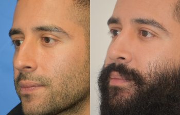 Male patient before and after rhinoplasty