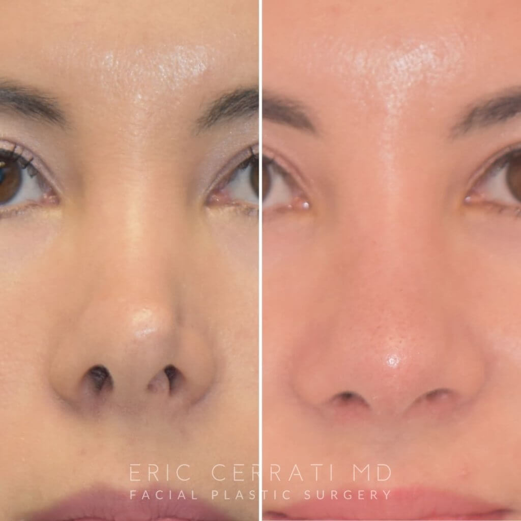 Female patient before and after rhinoplasty