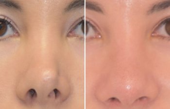 Female patient before and after rhinoplasty