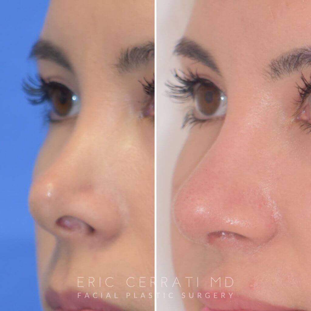 Female patient before and after rhinoplasty
