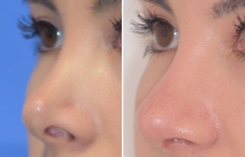 Female patient before and after rhinoplasty