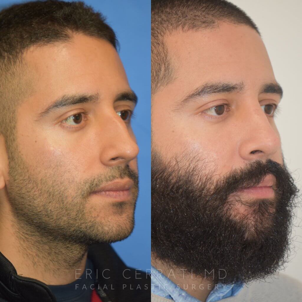 Male patient before and after rhinoplasty