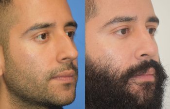 Male patient before and after rhinoplasty