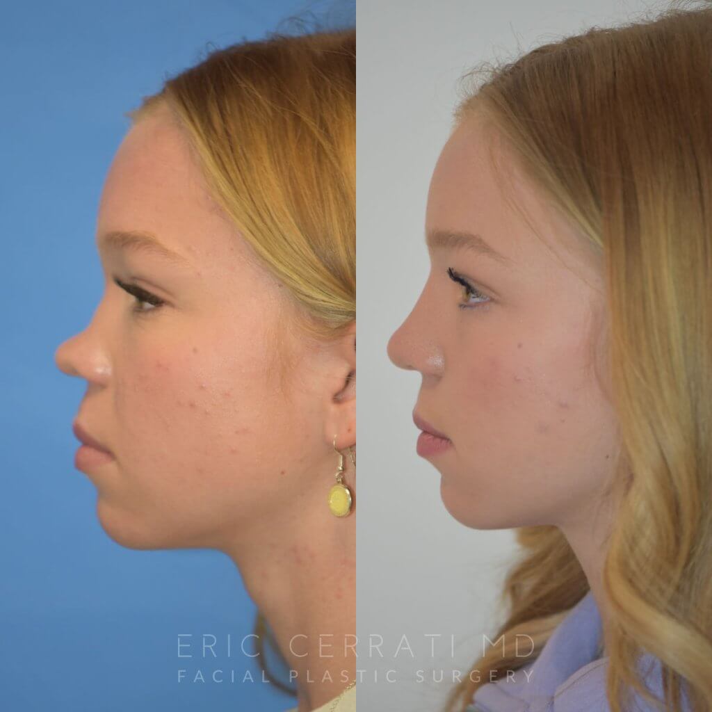 Female patient before and after rhinoplasty