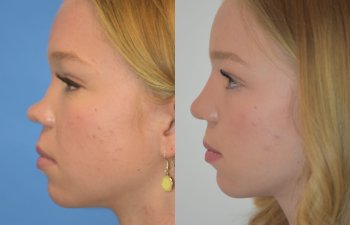 Female patient before and after rhinoplasty