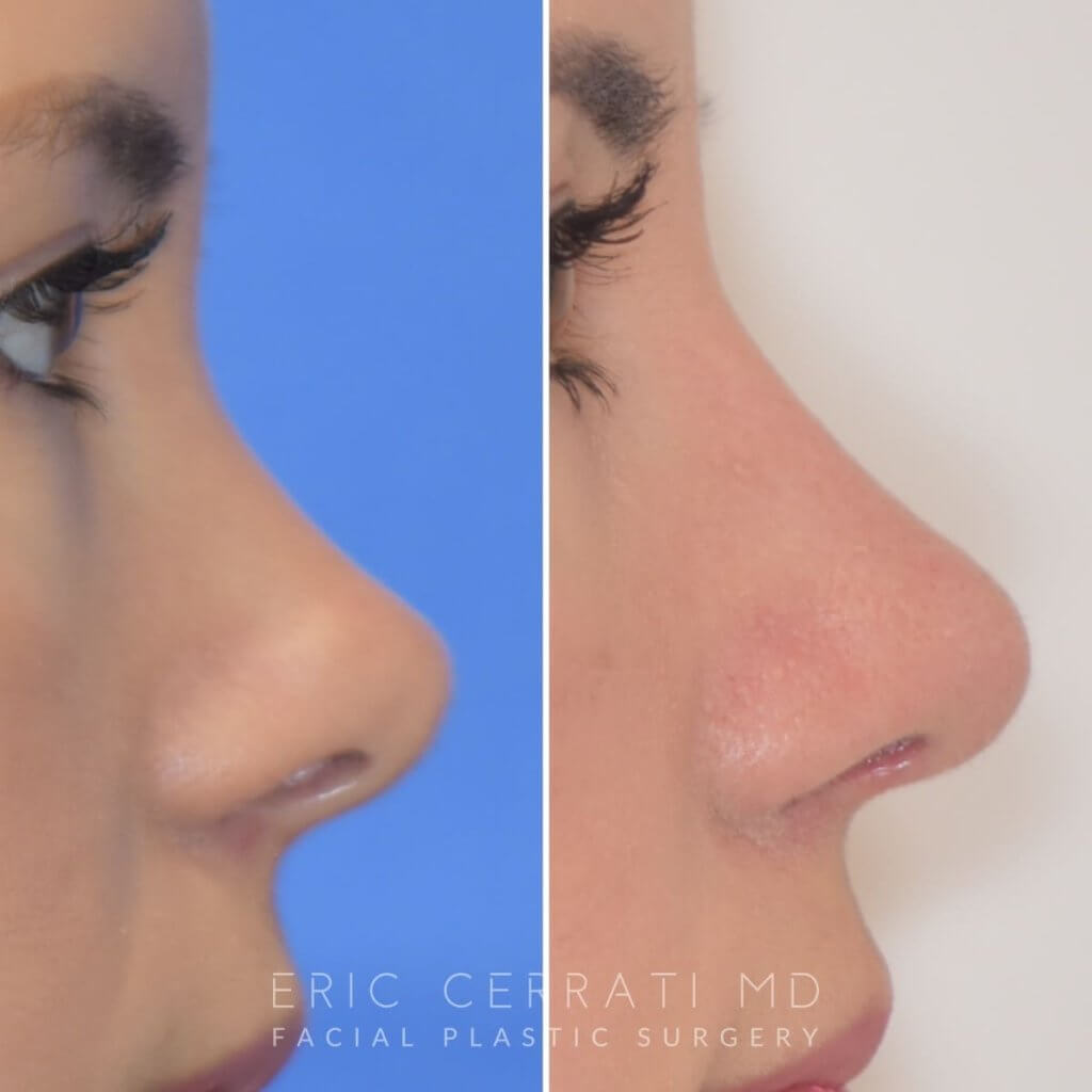 Female patient before and after rhinoplasty