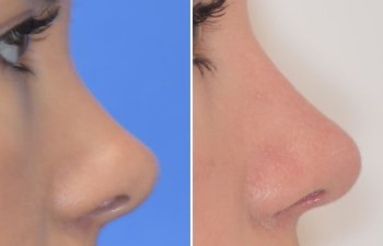Female patient before and after rhinoplasty