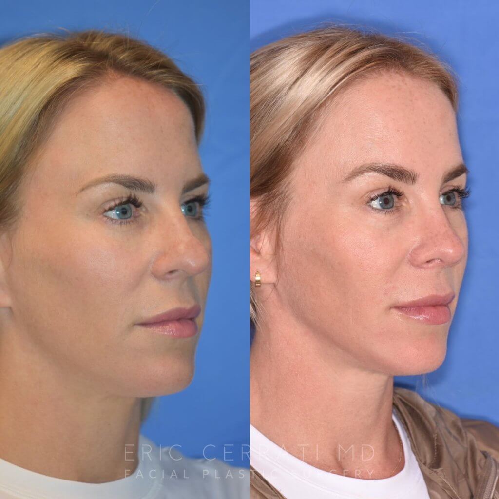 Female patient before and after rhinoplasty