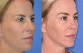 Female patient before and after rhinoplasty