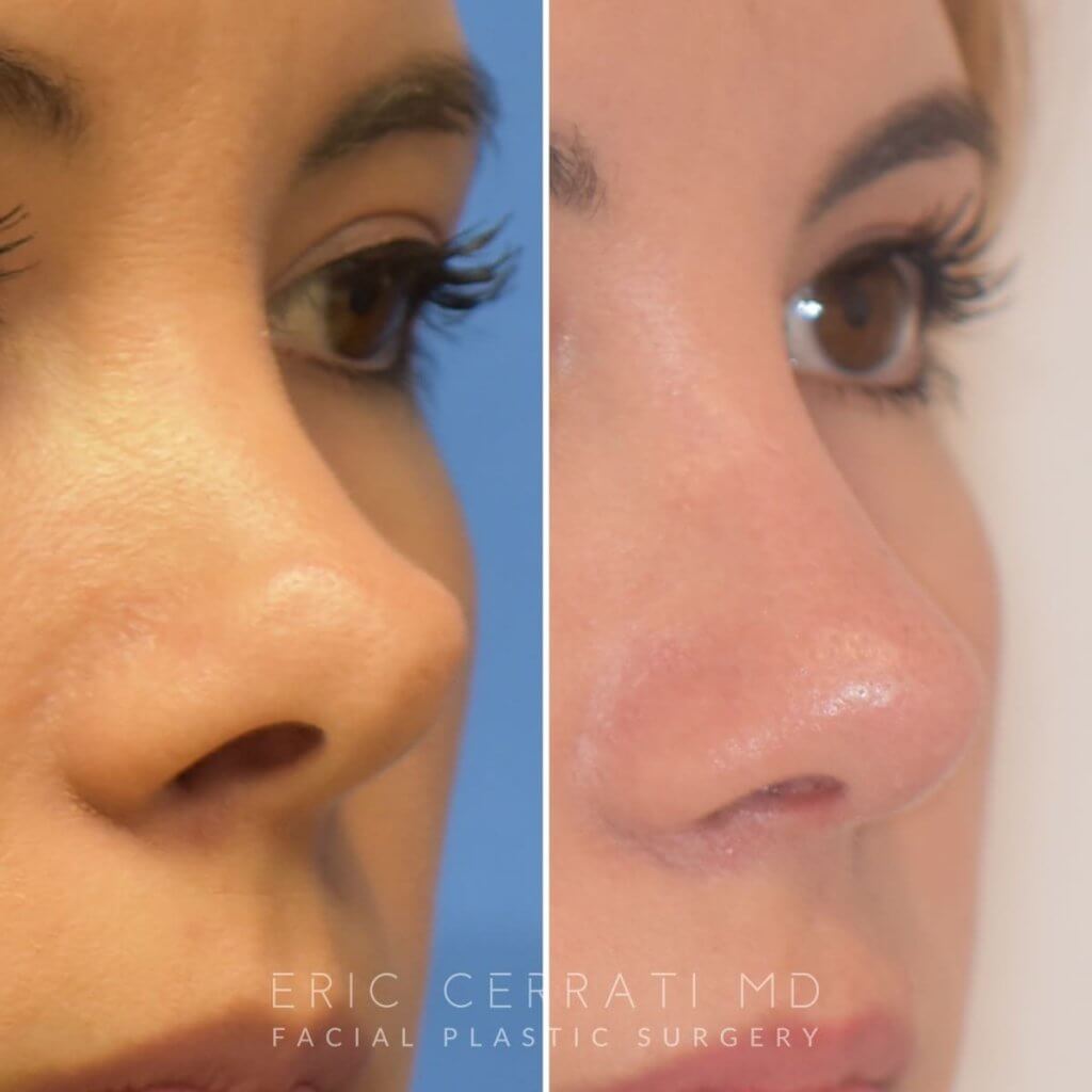 Female patient before and after rhinoplasty