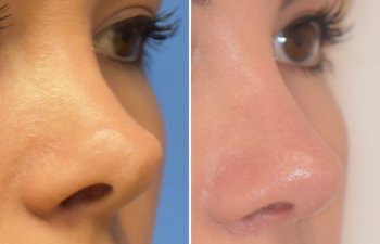 Female patient before and after rhinoplasty