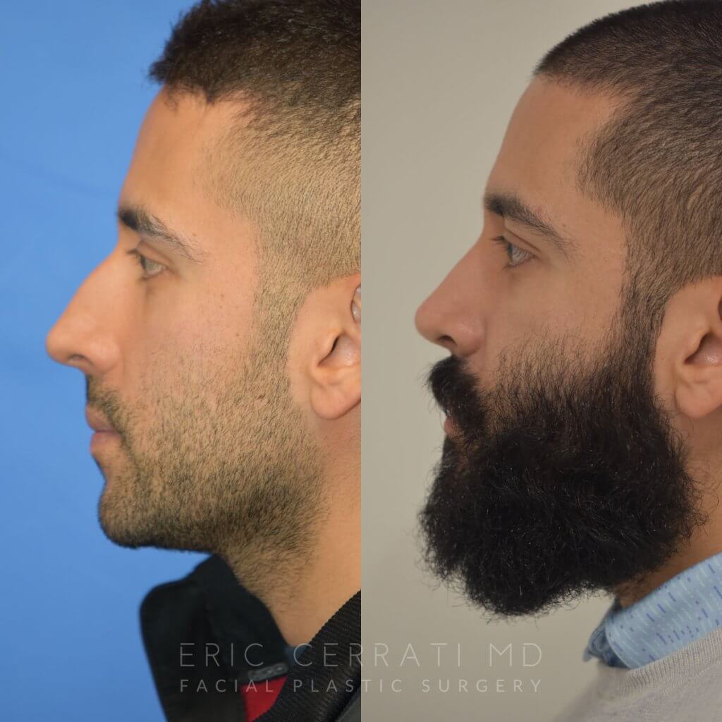 Male patient before and after rhinoplasty