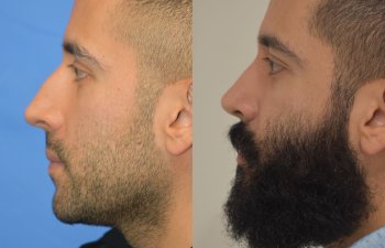 Male patient before and after rhinoplasty