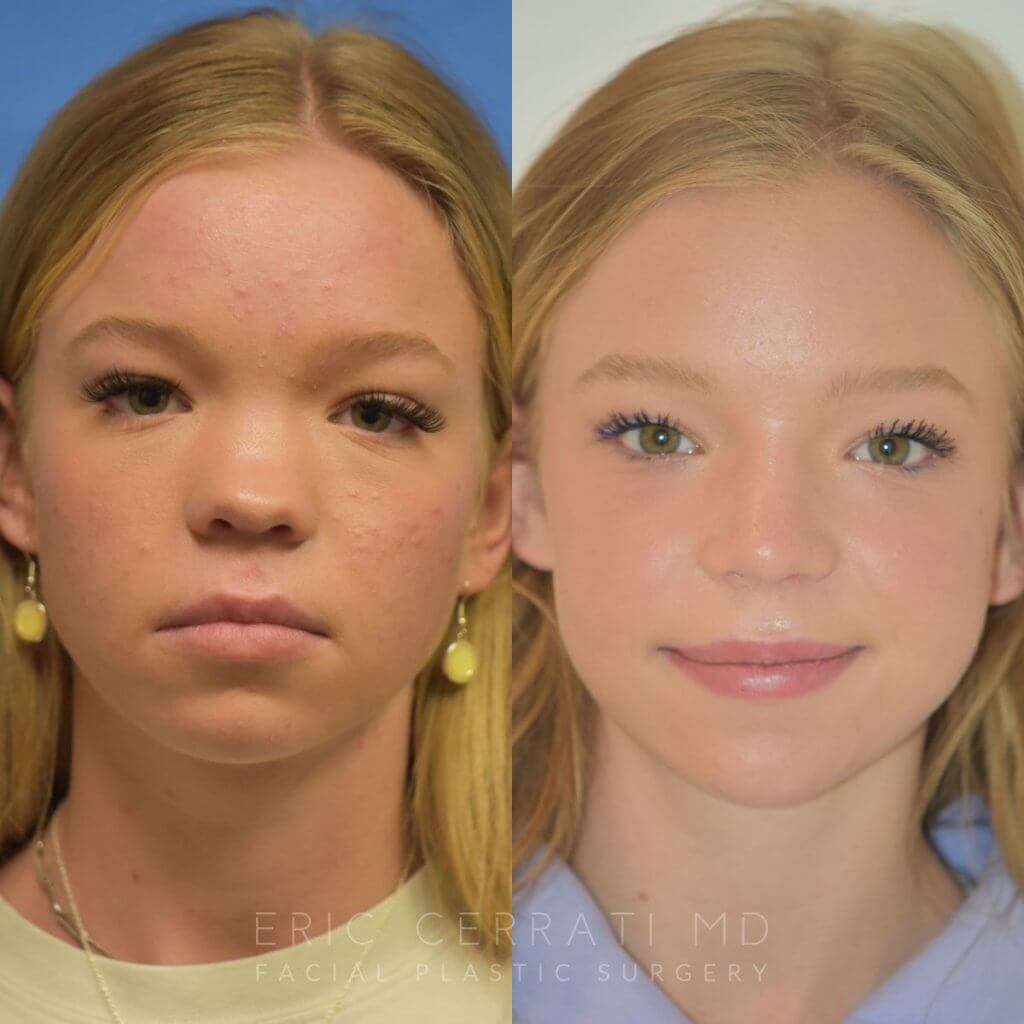 Female patient before and after rhinoplasty