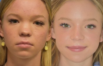 Female patient before and after rhinoplasty