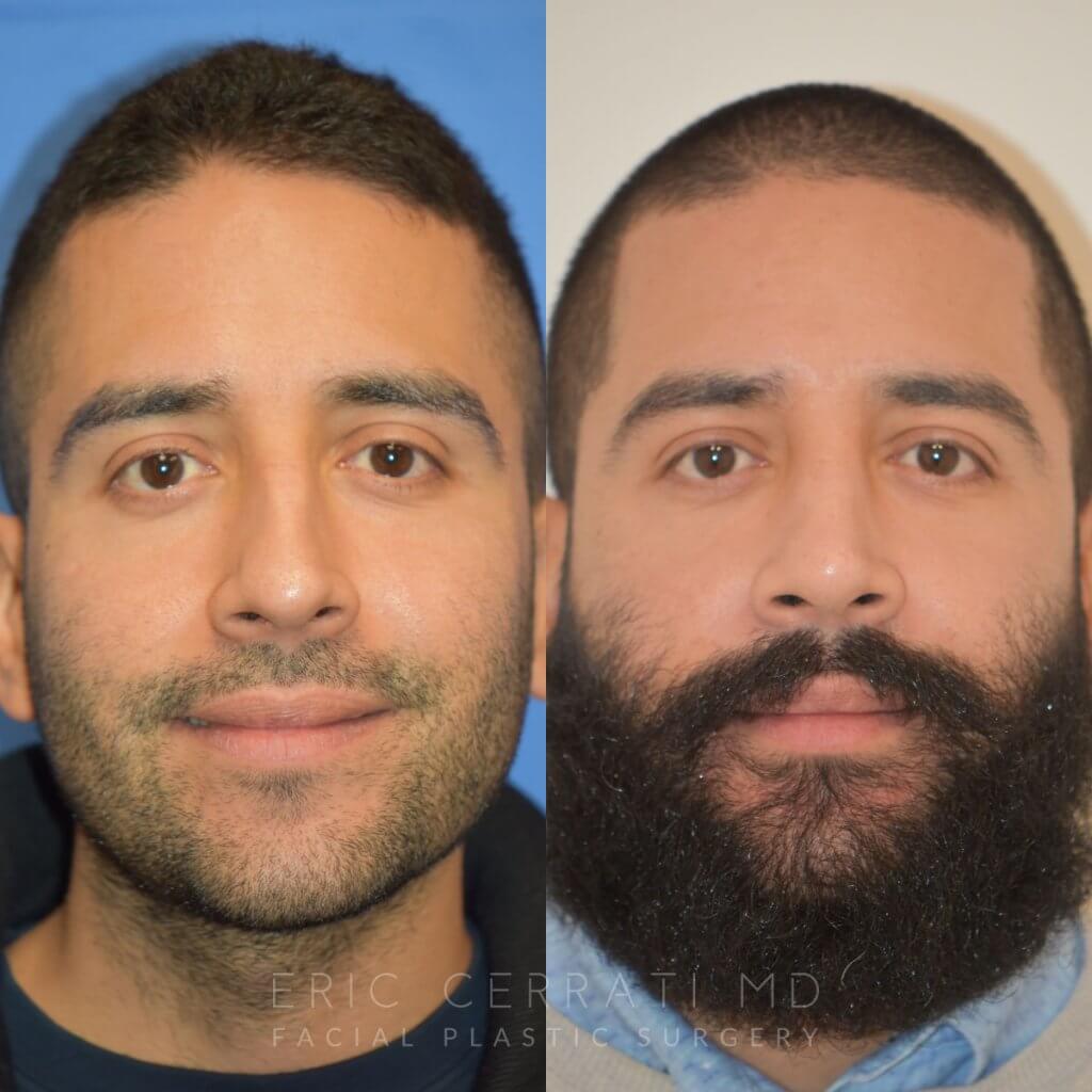 Male patient before and after rhinoplasty