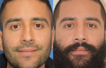 Male patient before and after rhinoplasty