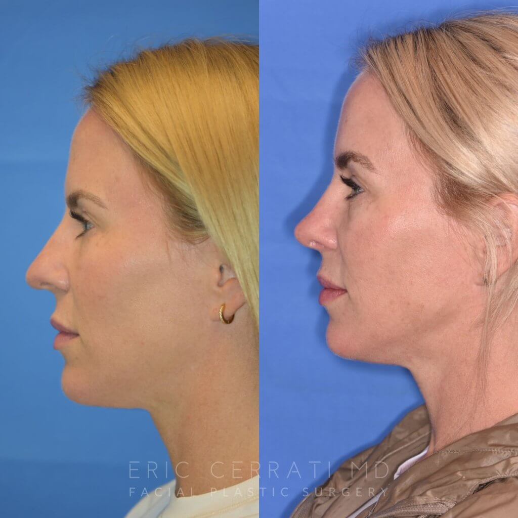 Female patient before and after rhinoplasty