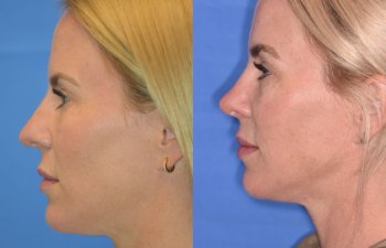 Female patient before and after rhinoplasty