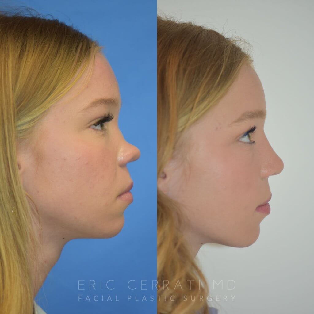 Female patient before and after rhinoplasty