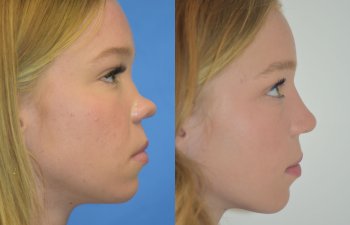 Female patient before and after rhinoplasty