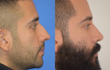 Male patient before and after rhinoplasty