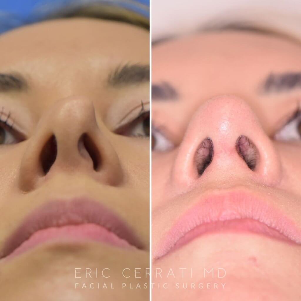 Female patient before and after rhinoplasty