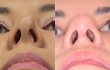 Female patient before and after rhinoplasty