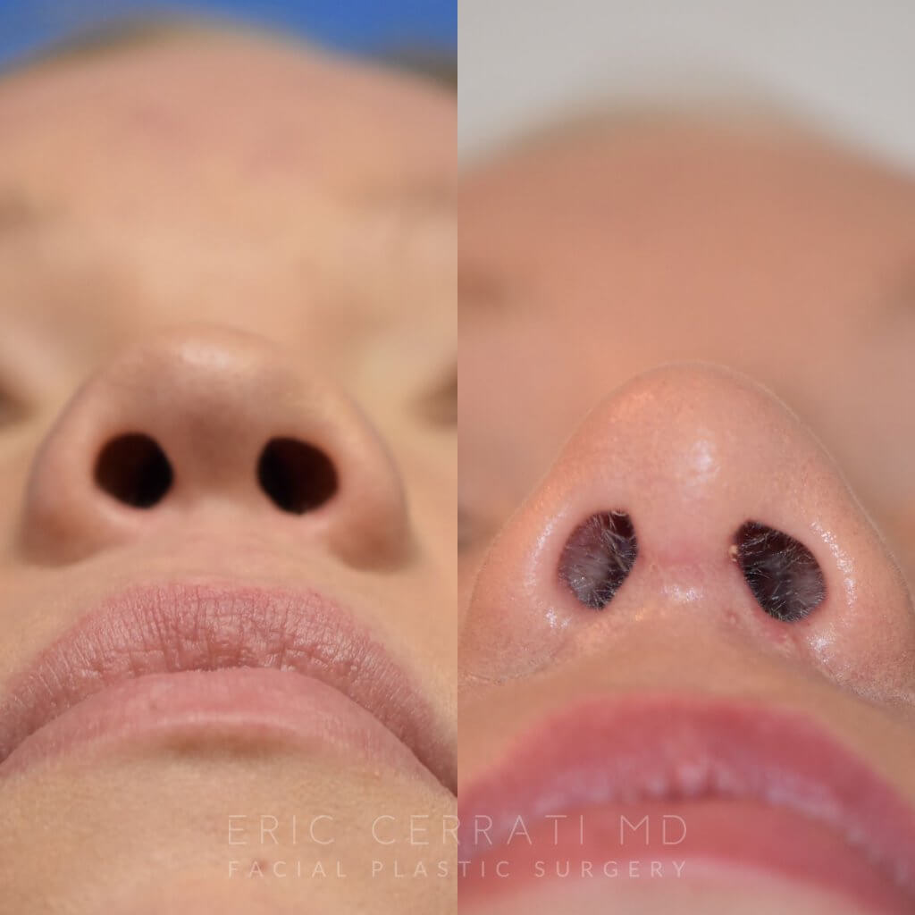 Female patient before and after rhinoplasty