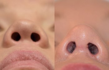 Female patient before and after rhinoplasty