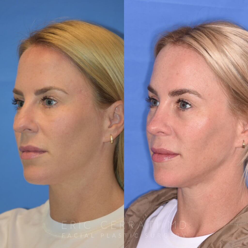 Female patient before and after rhinoplasty