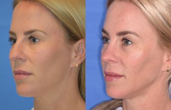 Female patient before and after rhinoplasty