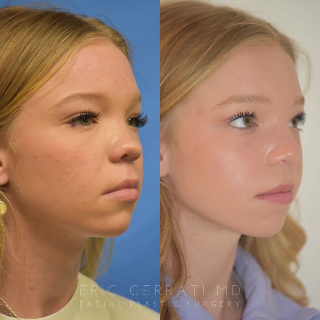Female patient before and after rhinoplasty