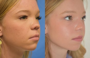 Female patient before and after rhinoplasty