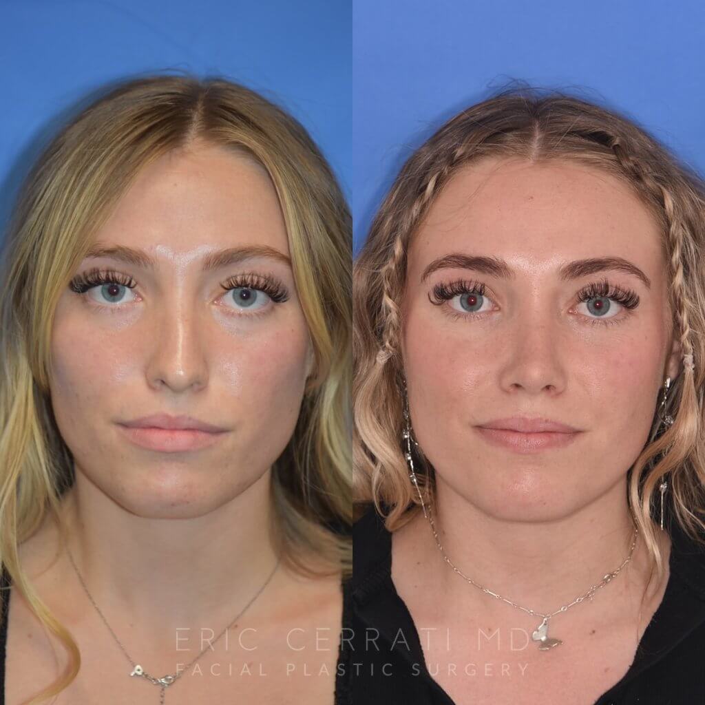 Female patient before and after rhinoplasty