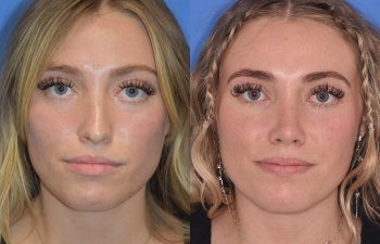 Female patient before and after rhinoplasty
