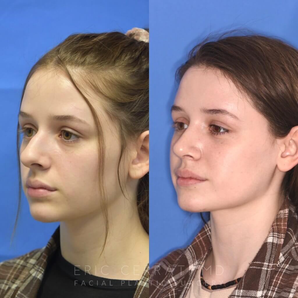 Female patient before and after rhinoplasty procedure