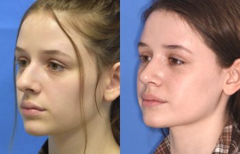 Female patient before and after rhinoplasty procedure